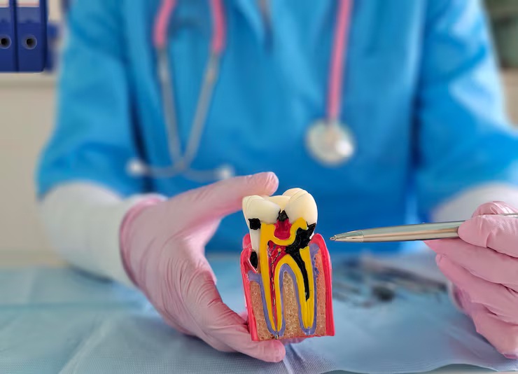 root canal in Century city