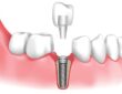 dental implant