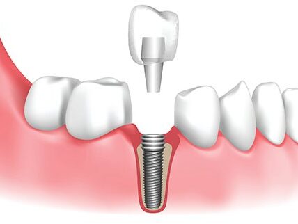 dental implant